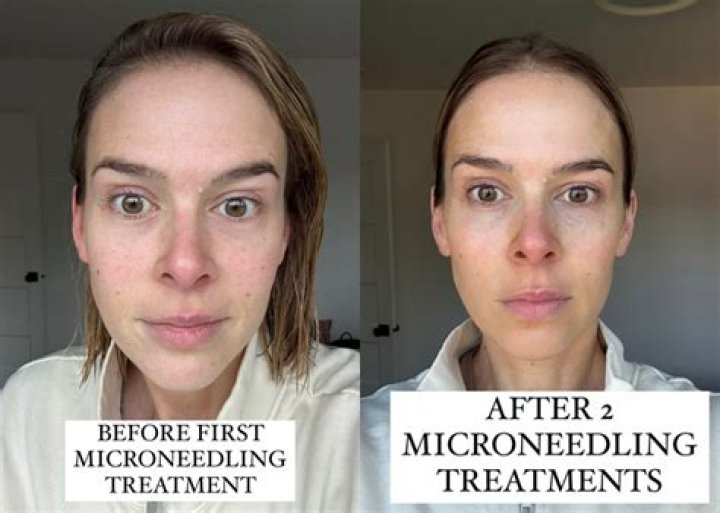 Can Microneedling be done around eyes?