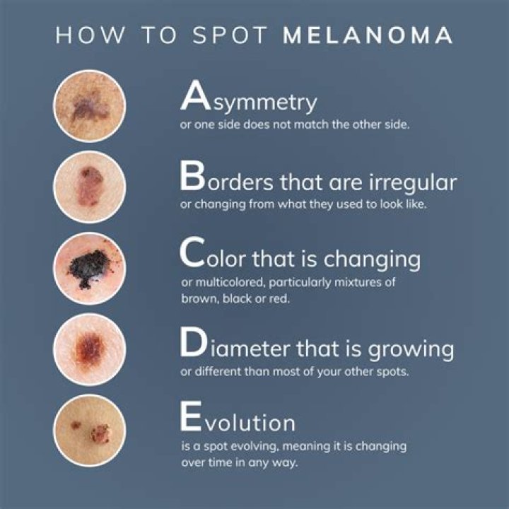 Can you get melanoma on your buttocks?