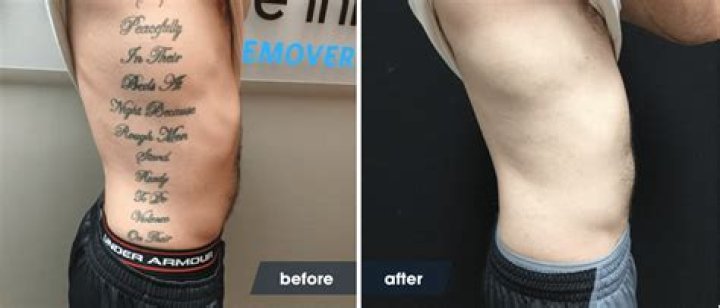 How soon after a tattoo can you have it removed?