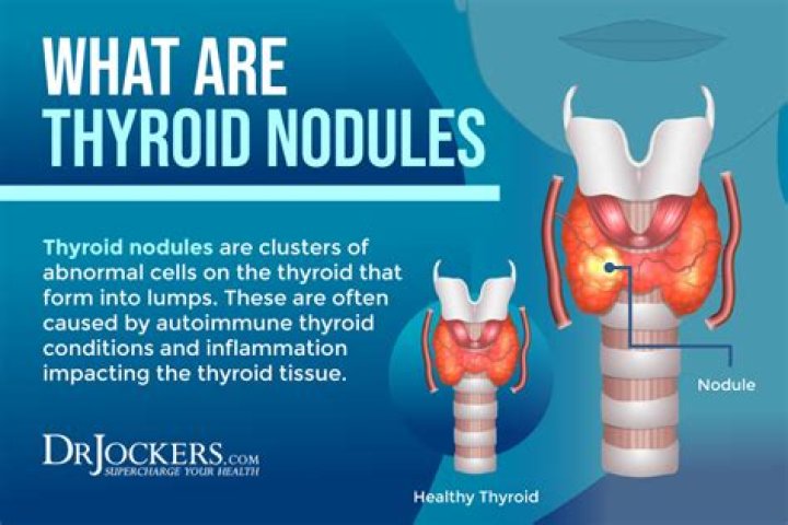 What causes throat nodules?