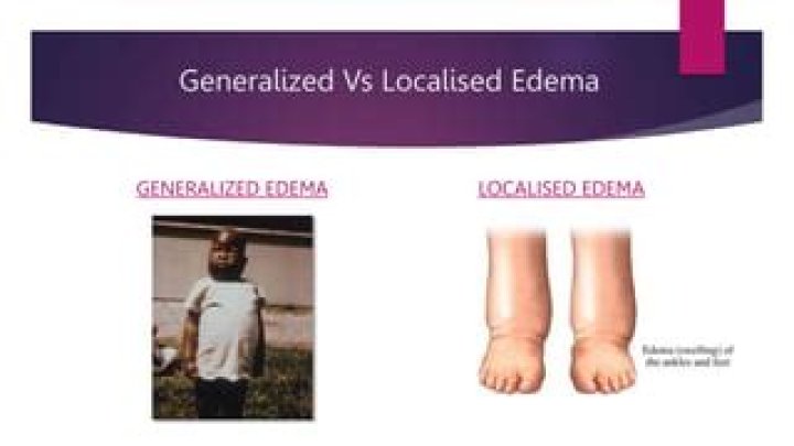 What is localized vs generalized edema?