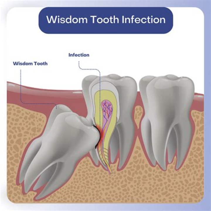 When tooth infection spreads to the bone?